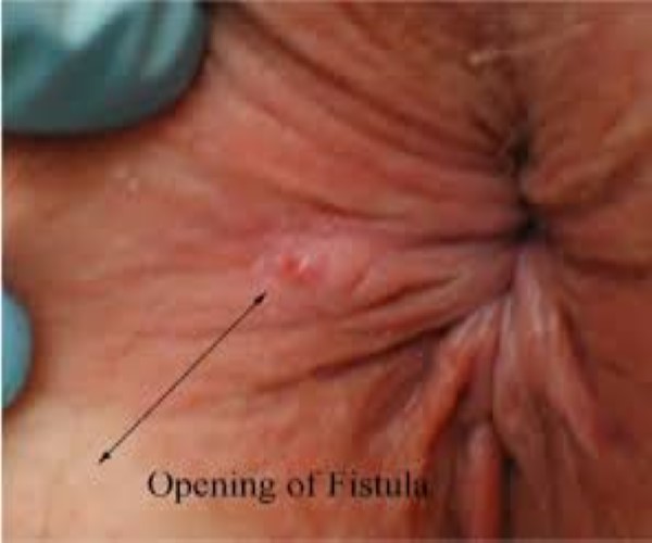 Piles, Fissure, Fistula Treatment in Kharghar, Panvel