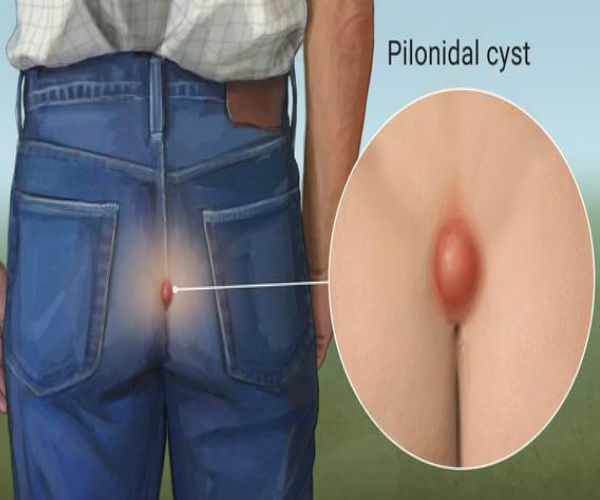 Pilonidal sinus